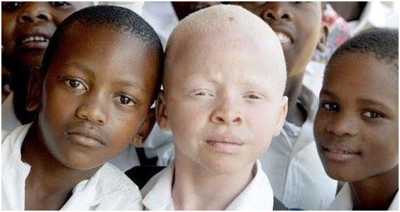 Protezione albini